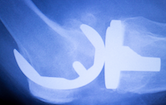 knee_replacement_4.png