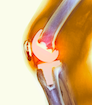 knee_replacement_5.png