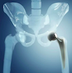 hip_replacement_7.png