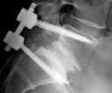 spinal_fusion_2.jpg