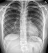 pectus excavatum