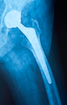 hip_replacement_2.png
