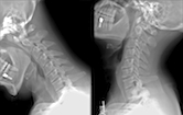 cervical curves and injuries