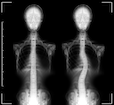 spinal_scoliosis_3.png