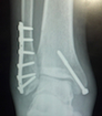 ankle repairs