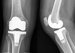knee_replacement_3.png